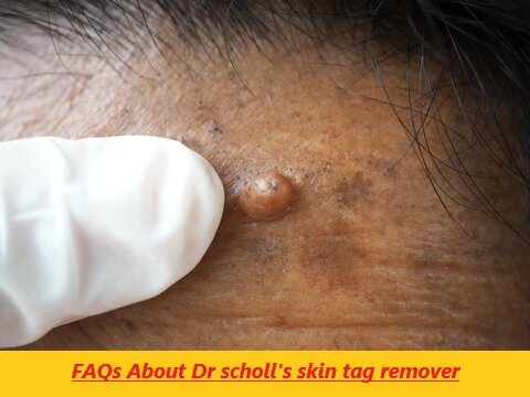 Dr scholl's skin tag remover